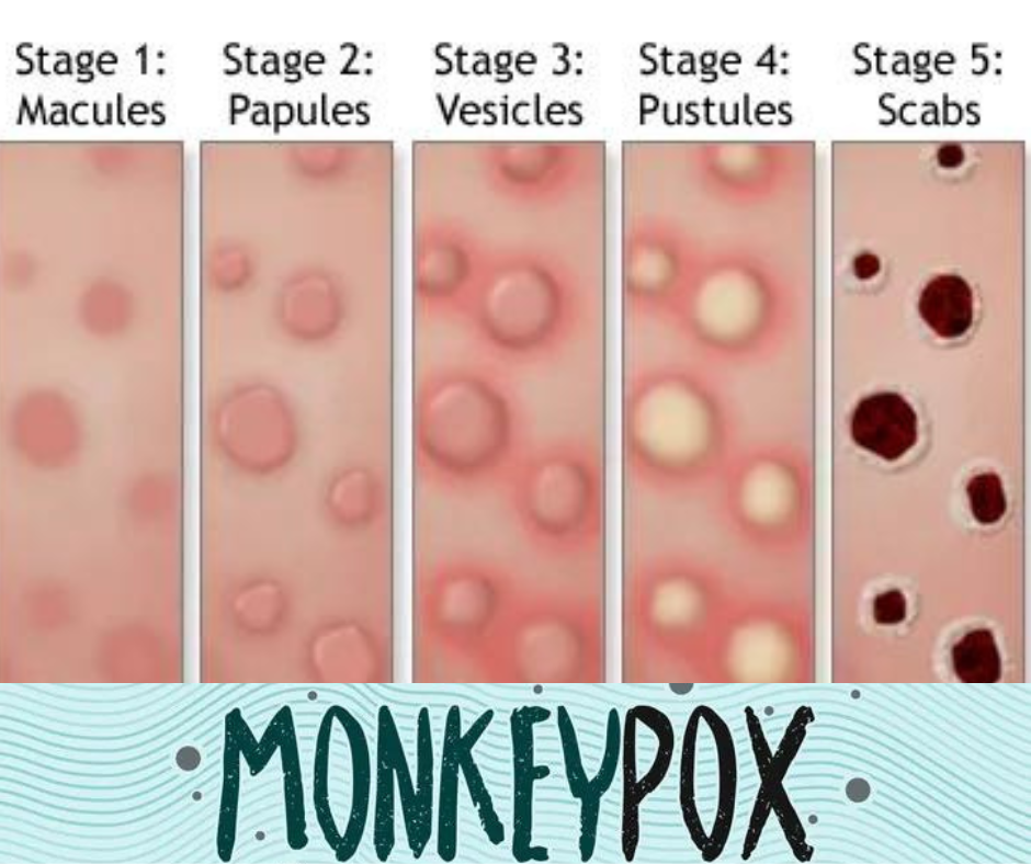 Monkeypox